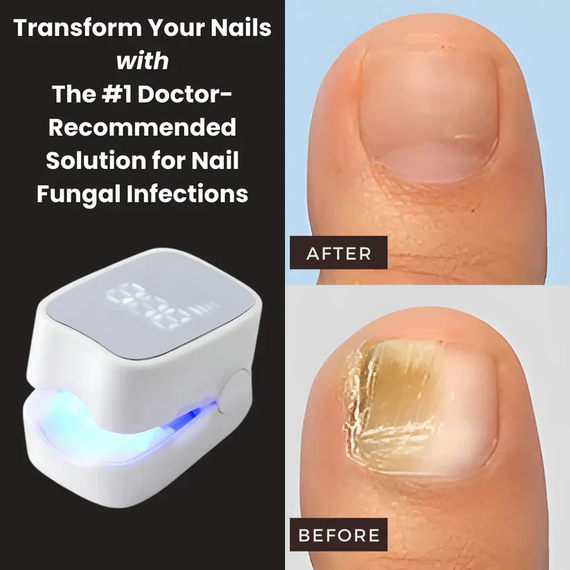 Before and after fingernail fungus treatment using ClearNail Pro laser device, showing visibly clearer and healthier nails